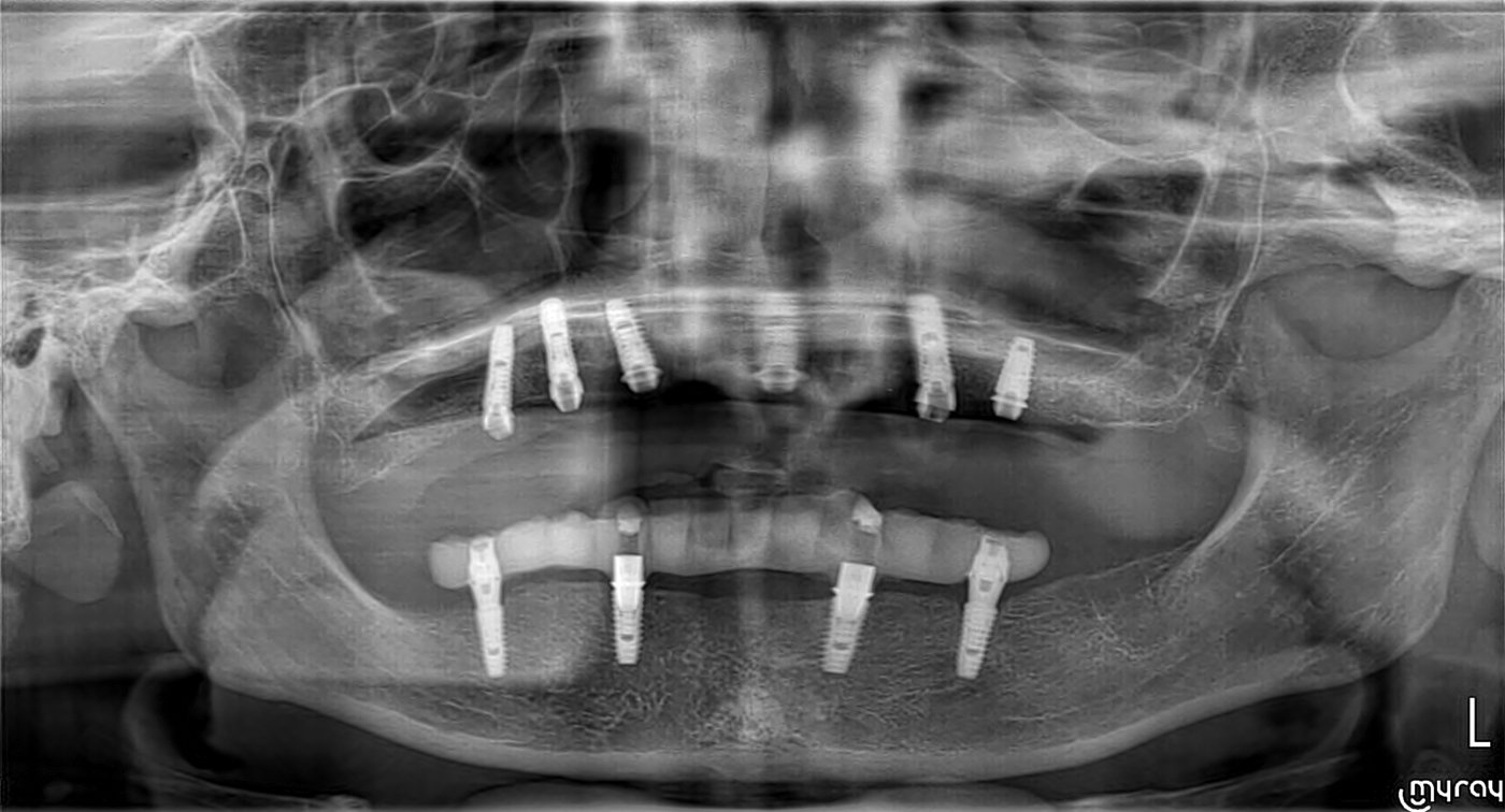 Radiografie panoramică după inserarea a șase implanturi la maxilar și patru la mandibulă