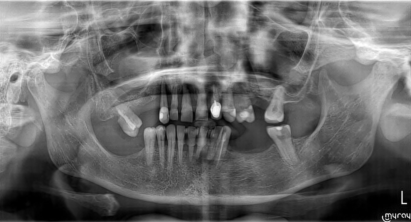 Radiografie panoramică înainte de tratament, cu dinții rămași pe ambele arcade