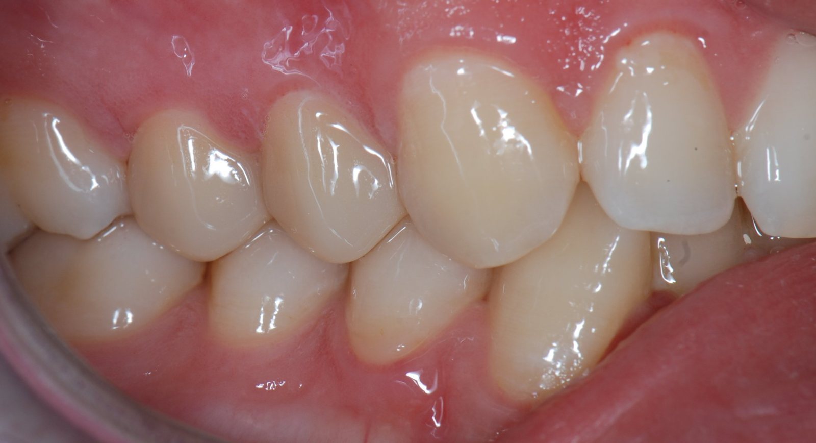 Coroane ceramice unidentare pe premolarii superiori