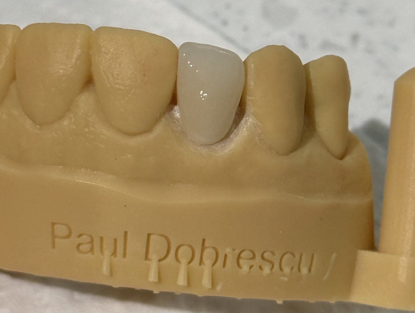 Fațetă din ceramică frezată pe incisivul lateral, pe modelul de lucru