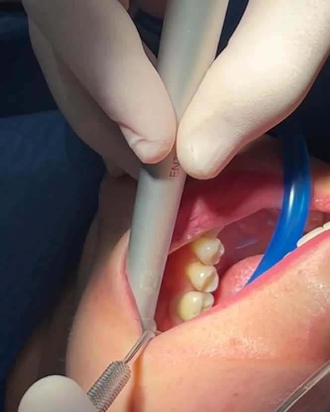 Piesa de mână a laserului dentar Er:YAG, în timpul unei proceduri