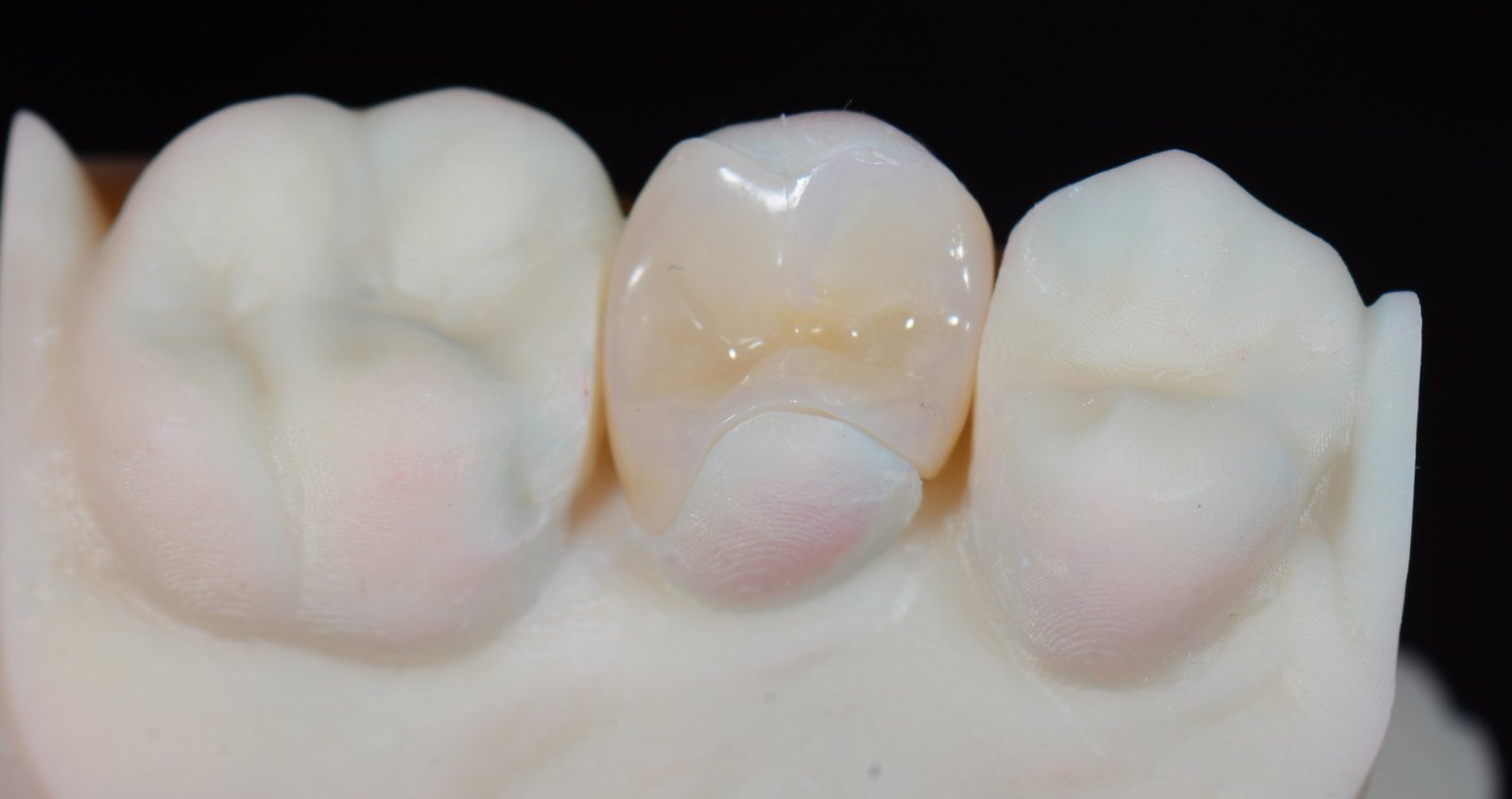Onlay ceramic pe un premolar, pe modelul de lucru