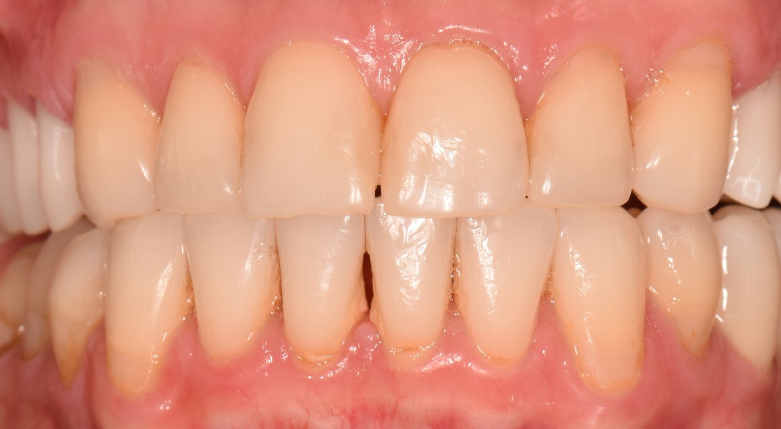 Retracții gingivale la dinții frontali inferiori, semn al bolii parodontale