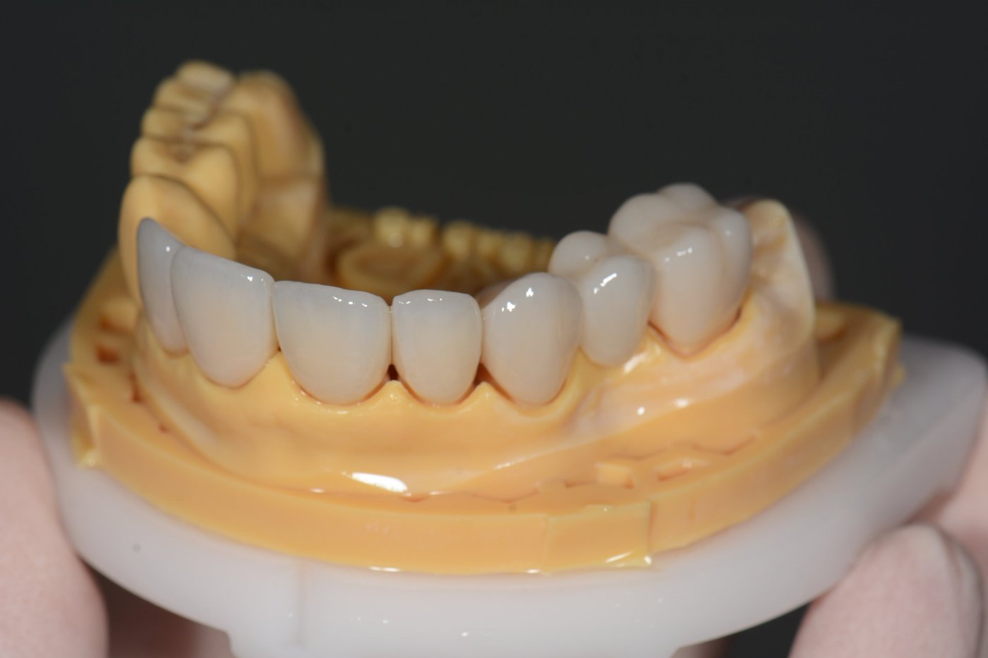Punte și coroane ceramice pe modelul de lucru