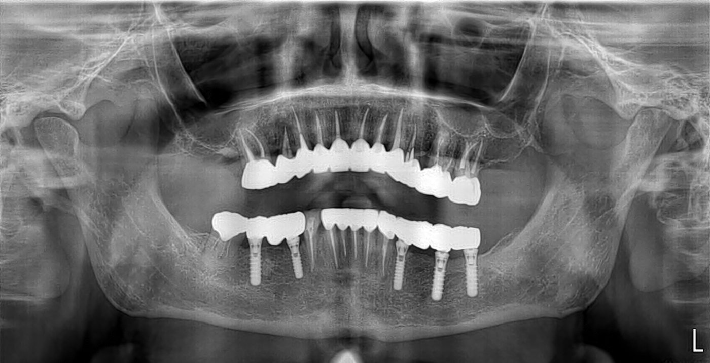 Radiografie panoramică după o reabilitare orală mixtă, cu lucrări pe dinți naturali și pe implanturi